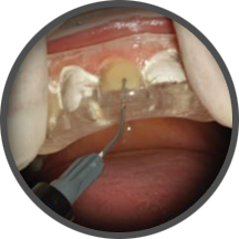 Composite Injection
