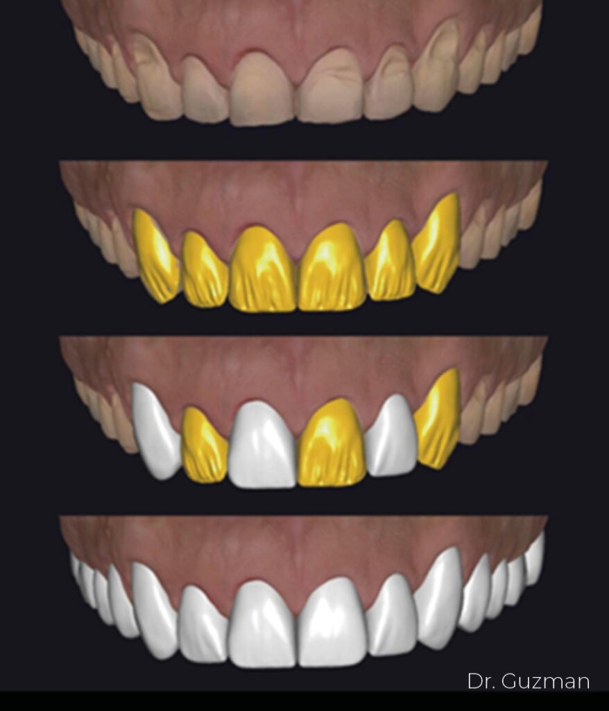 fit veneer process