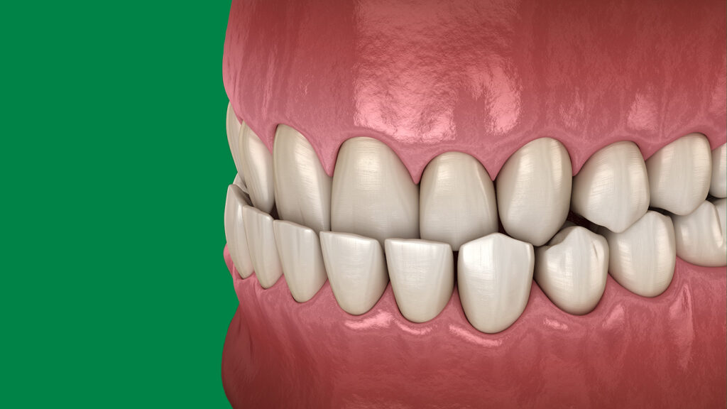 Crossbite & Underbite