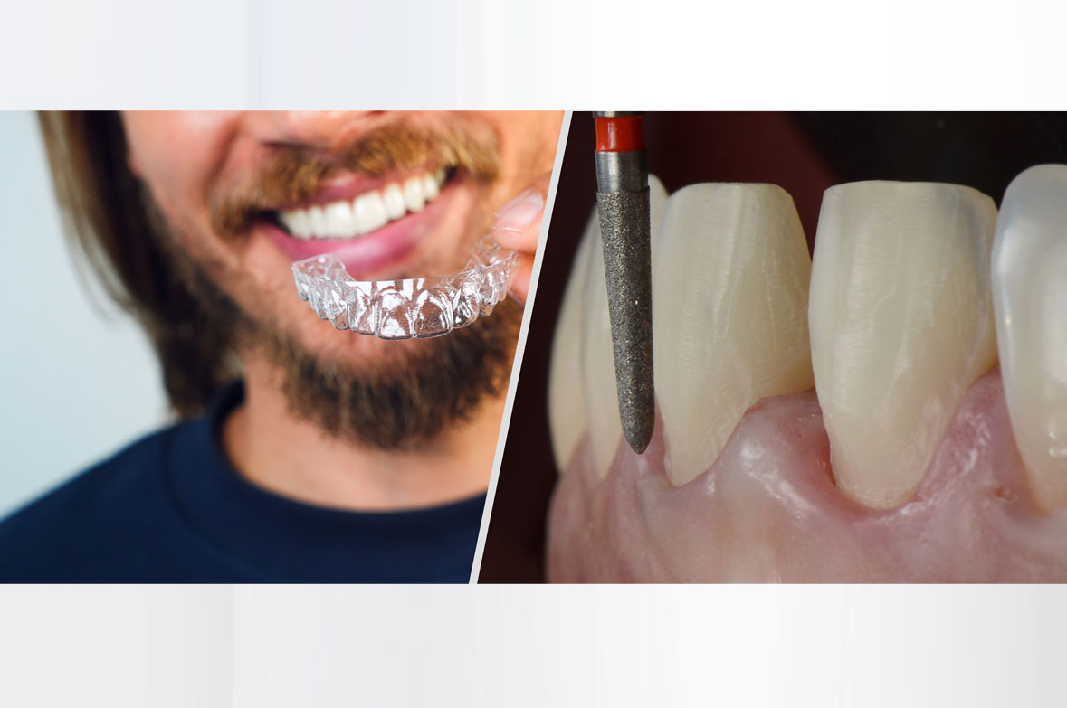 Pre-Restorative Alignment vs. Tooth Preparation: Which Approach is Right for Your Patients?