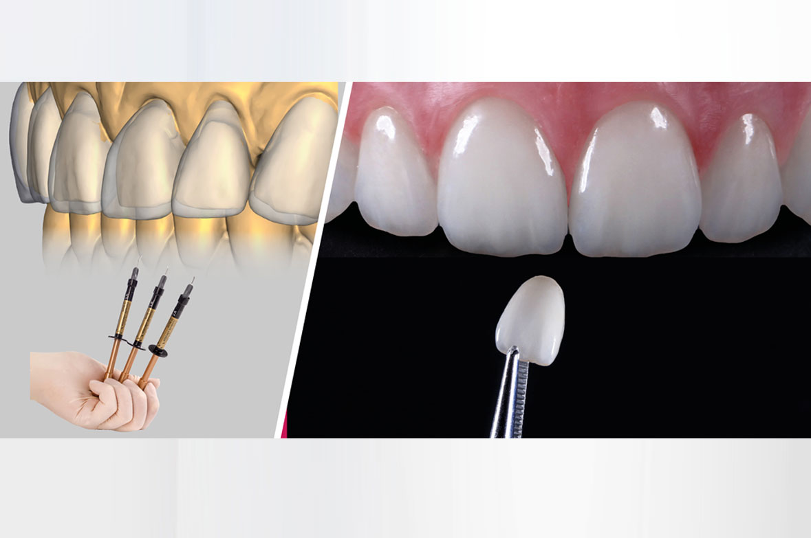 Discover the Perfect Veneer Solution: F.I.T. Veneers and ZirNEER