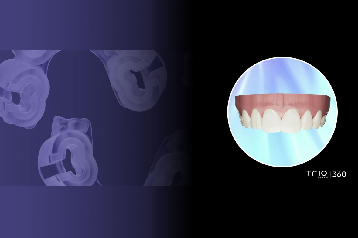 IPS e.max® Guided Veneer Treatment by TrioClear®360