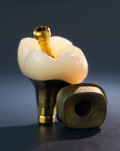 Single Implant Crowns